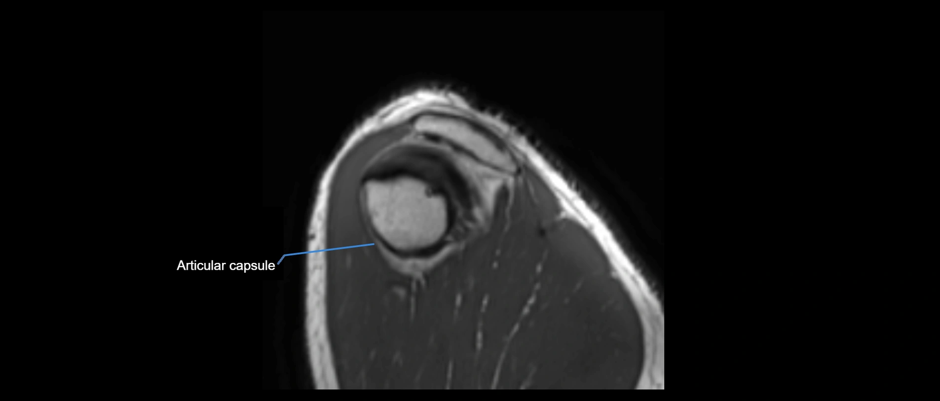 shoulder ligaments sagittal  cross sectional anatomy 3T MRI AI enhanced radiology image -img-00001-00053.webp